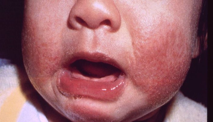baby-eczema-on-face