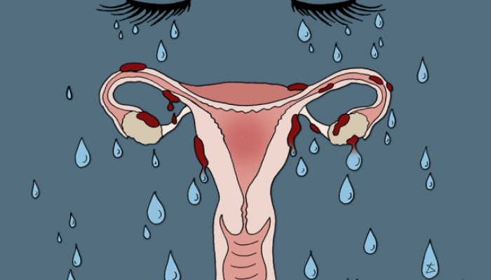 endometriosis_illustration_libertyantoniasadler_metro